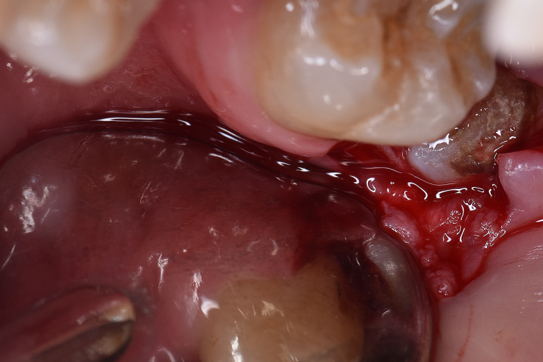 出,只有右下的智齿萌出一丁点,导致食物嵌塞在牙龈,使得牙龈反复发炎