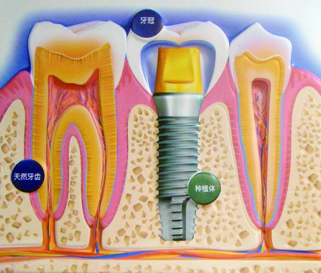 缺牙为什么种植牙？